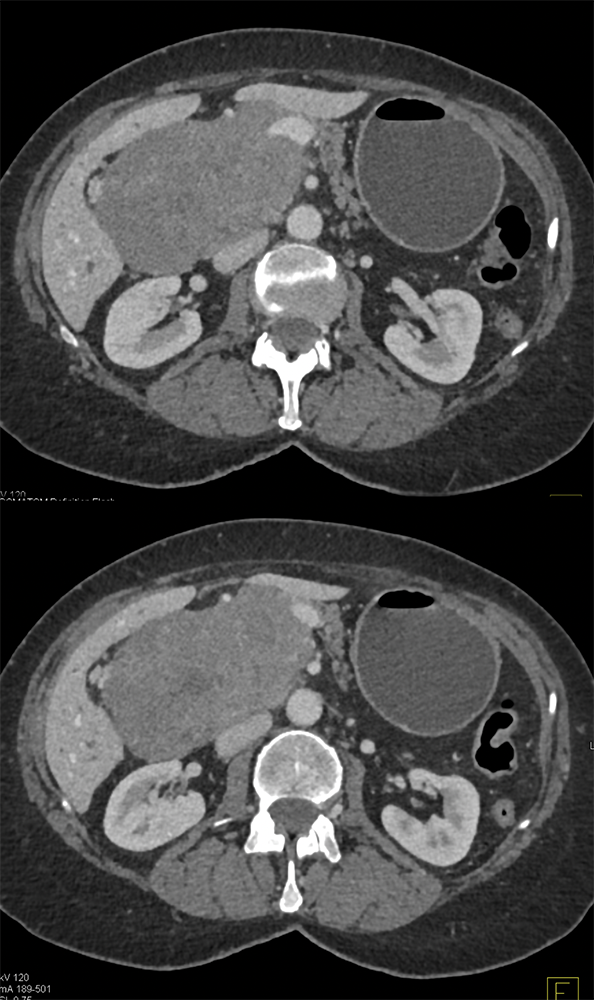 CT of Small Bowel Tumors