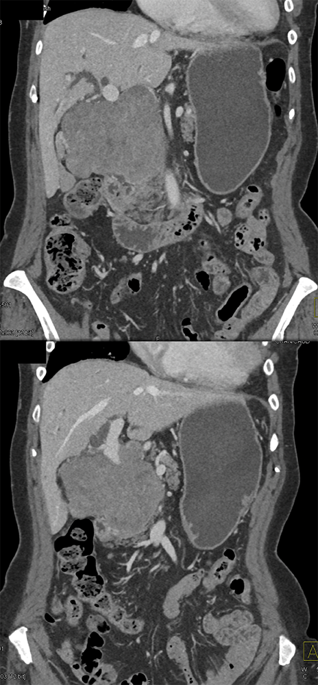 CT of Small Bowel Tumors