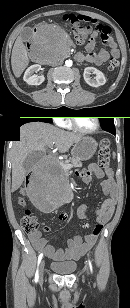 Metastatic Melanoma Metastatic to the Duodenum