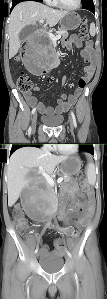 CT of Small Bowel Tumors