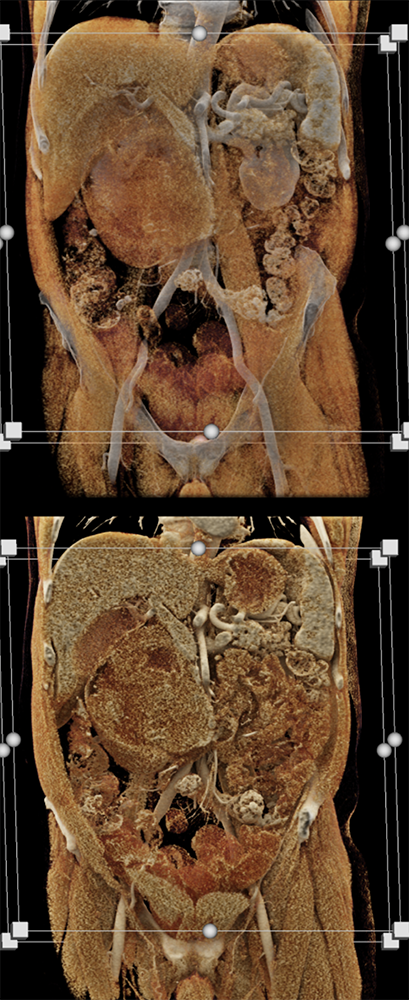 CT of Small Bowel Tumors