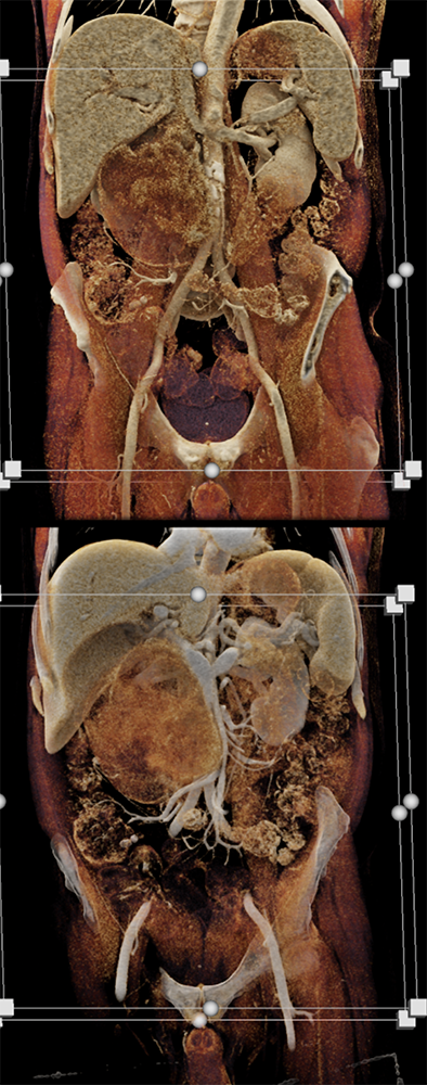 CT of Small Bowel Tumors