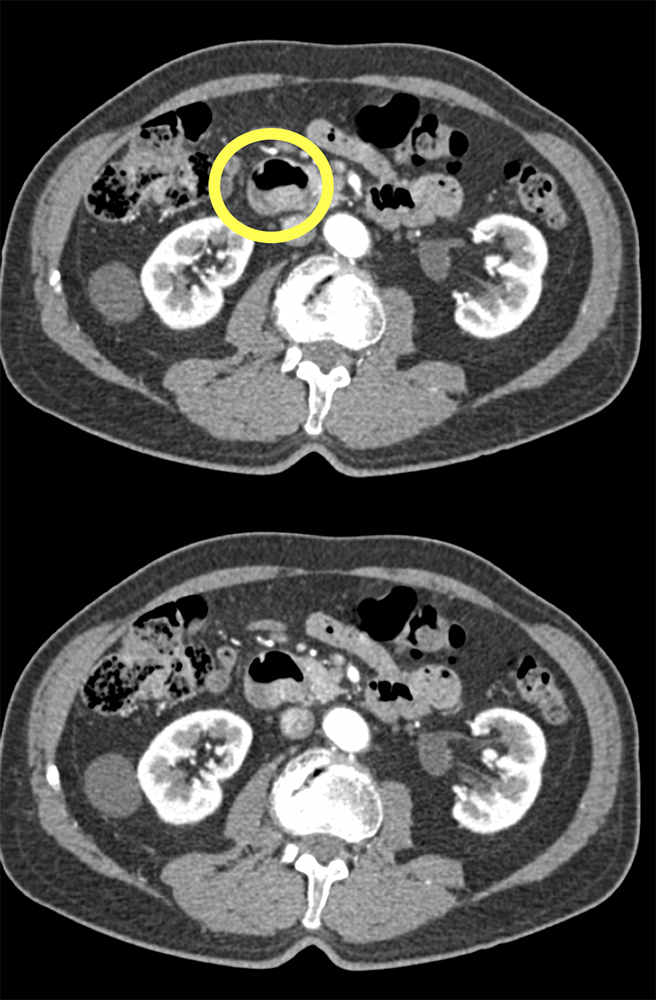 Metastatic Melanoma to Duodenum (subtle)