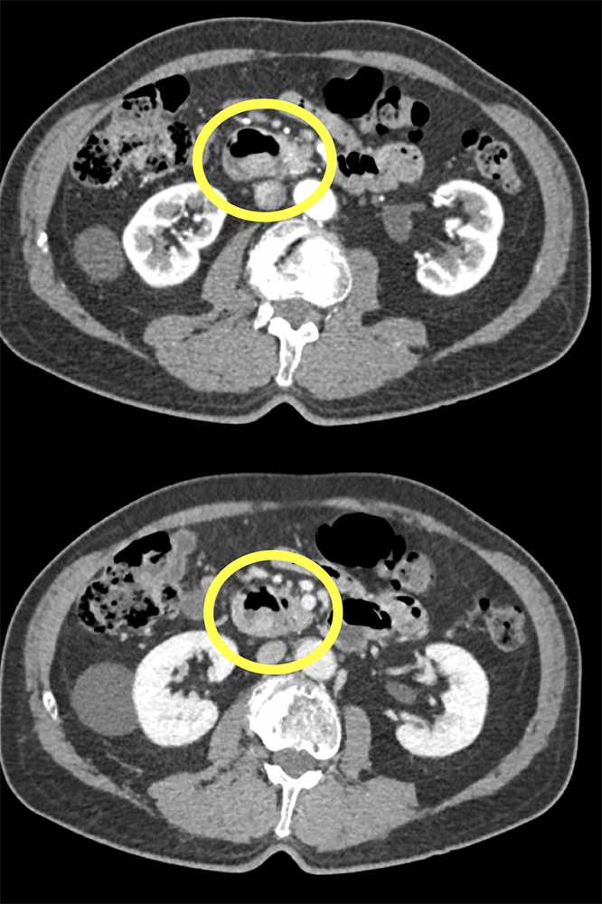 CT of Small Bowel Tumors