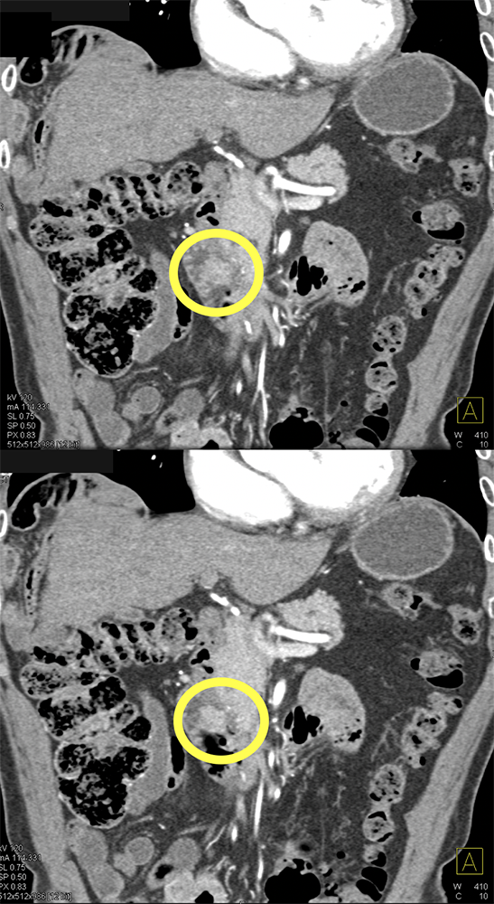 CT of Small Bowel Tumors