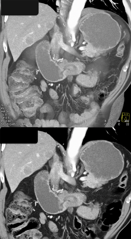 Small Bowel Adenocarcinoma