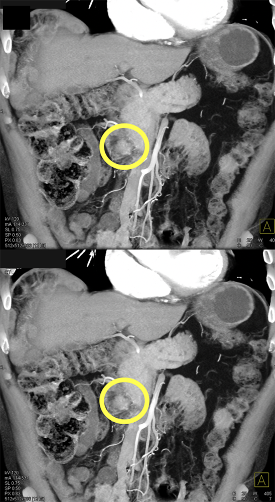 CT of Small Bowel Tumors