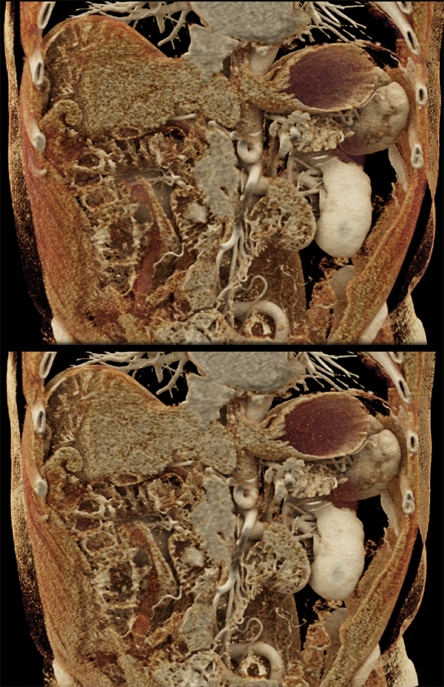 Metastatic Melanoma to Second Portion Duodenum