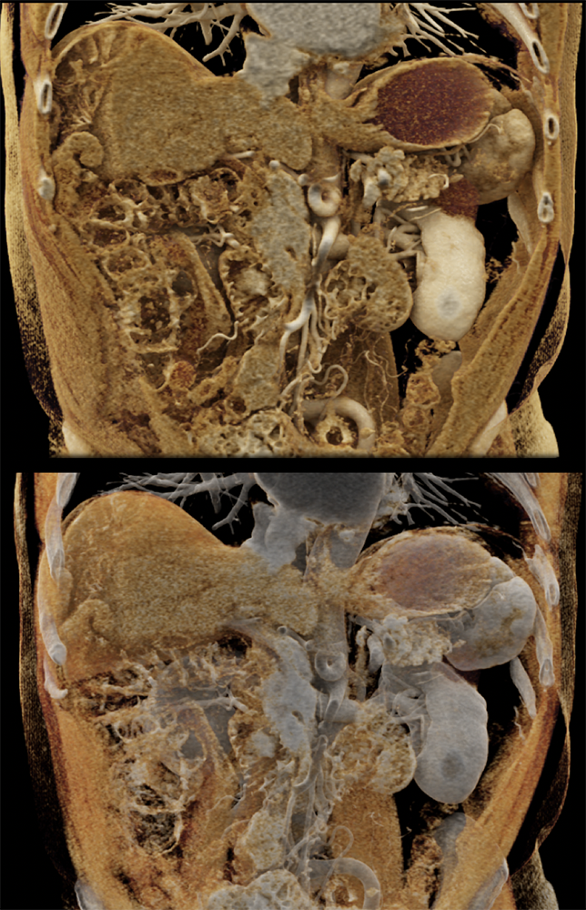 CT of Small Bowel Tumors