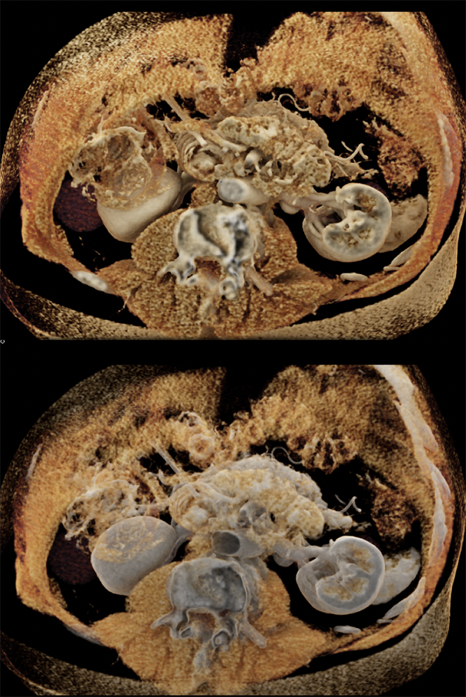 CT of Small Bowel Tumors