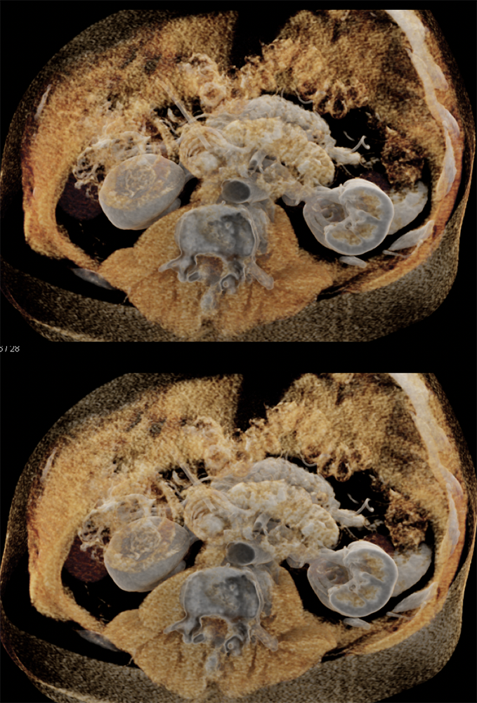 CT of Small Bowel Tumors