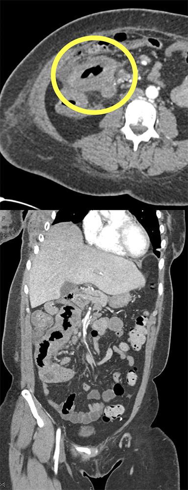 Breast Cancer Metastatic to the Jejunum