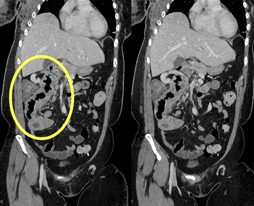 CT of Small Bowel Tumors