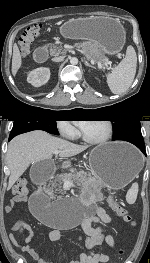 Carcinoma Tail of the Pancreas Invades the Duodenum