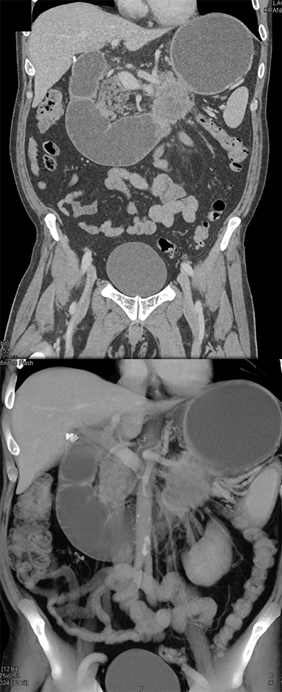 CT of Small Bowel Tumors