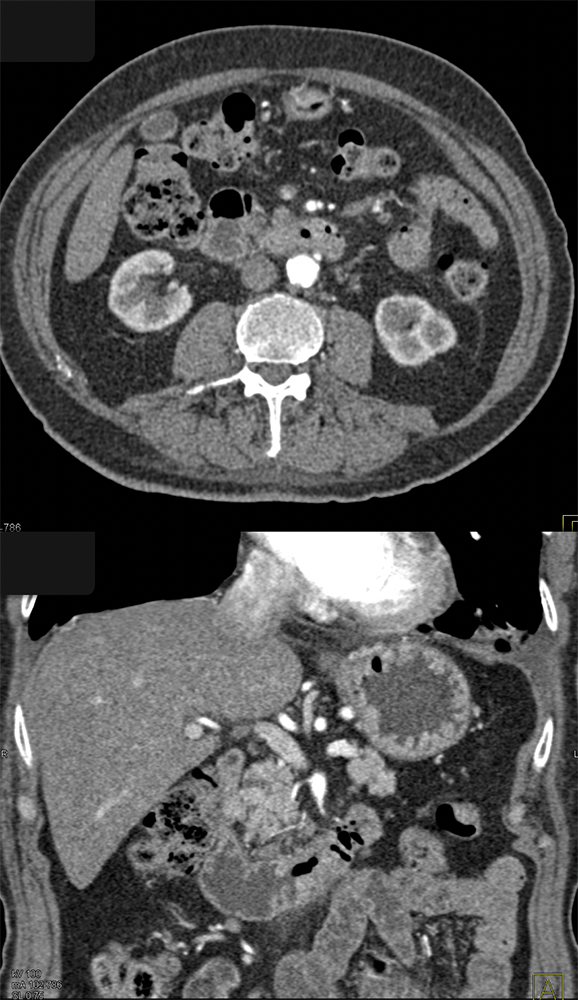 Adenocarcinoma Duodenum