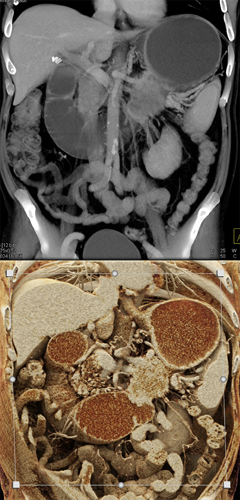 CT of Small Bowel Tumors