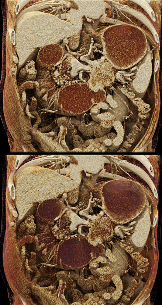 CT of Small Bowel Tumors