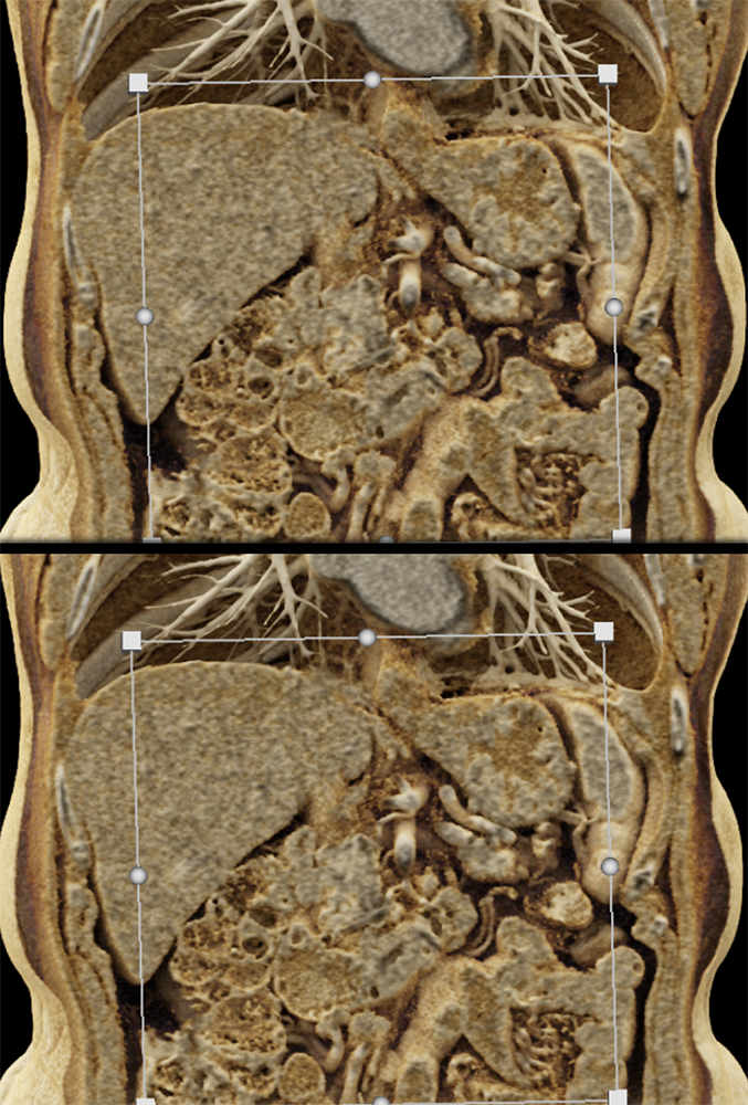 CT of Small Bowel Tumors