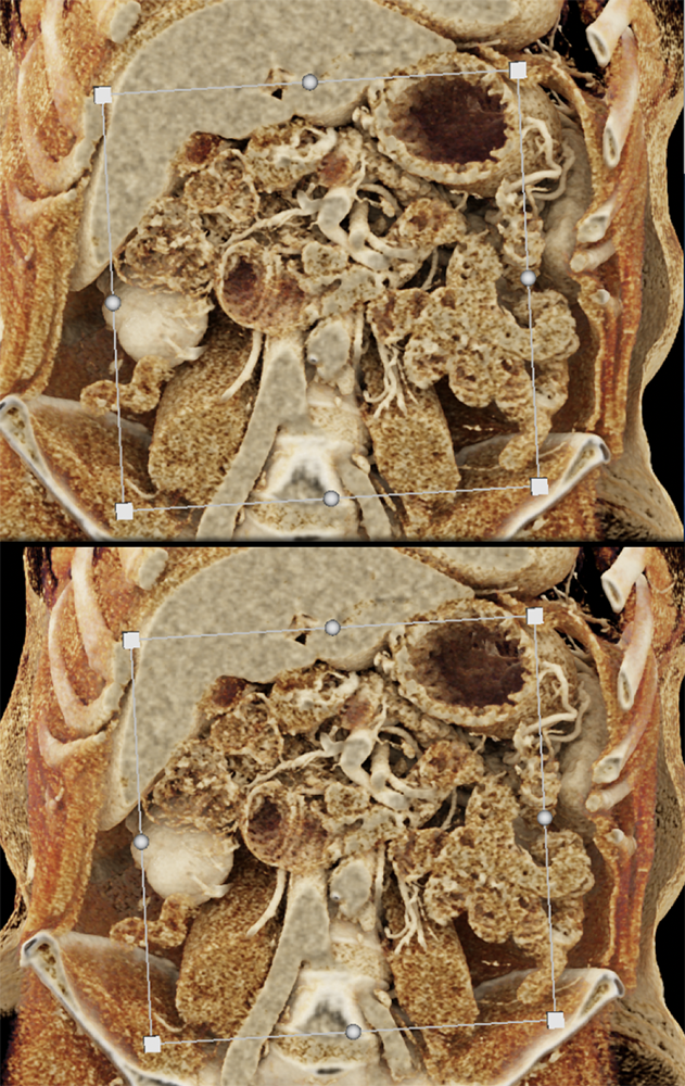 CT of Small Bowel Tumors