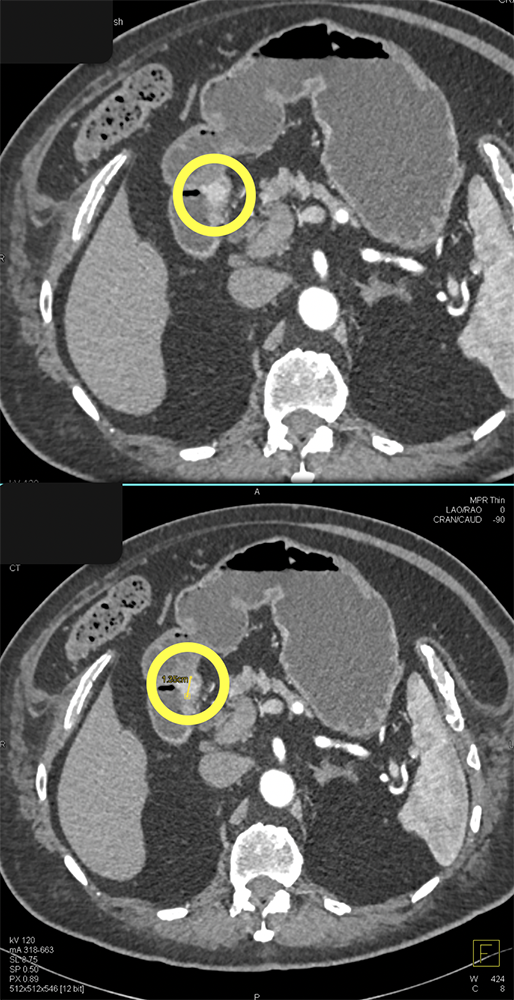 Subtle Tumor Duodenal Carcinoid 