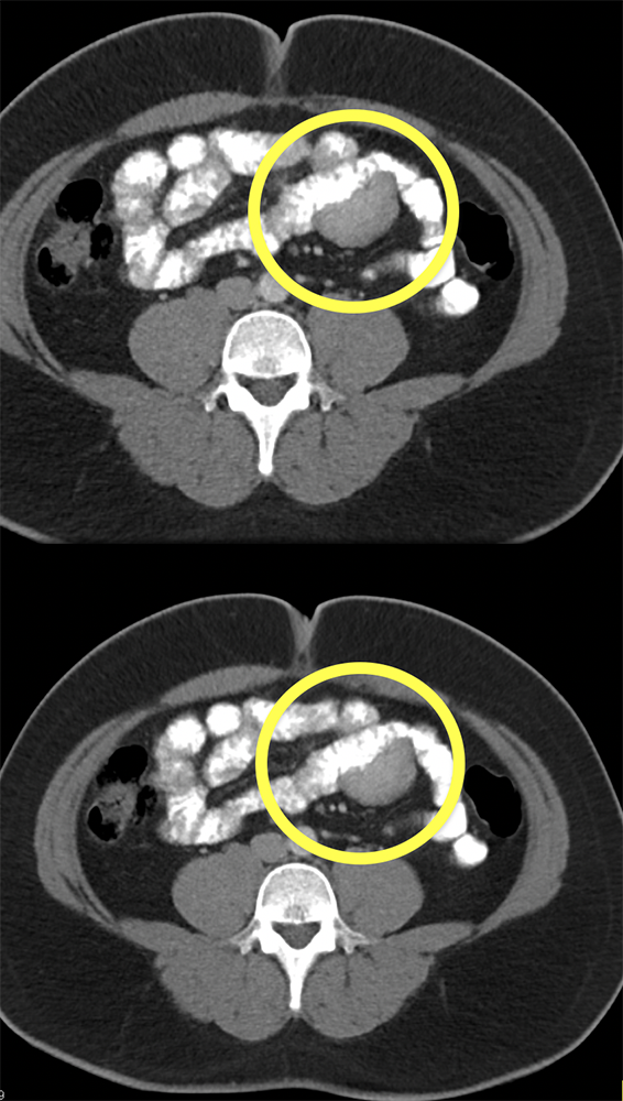 Small Bowel GIST Missed with Positive Contrast