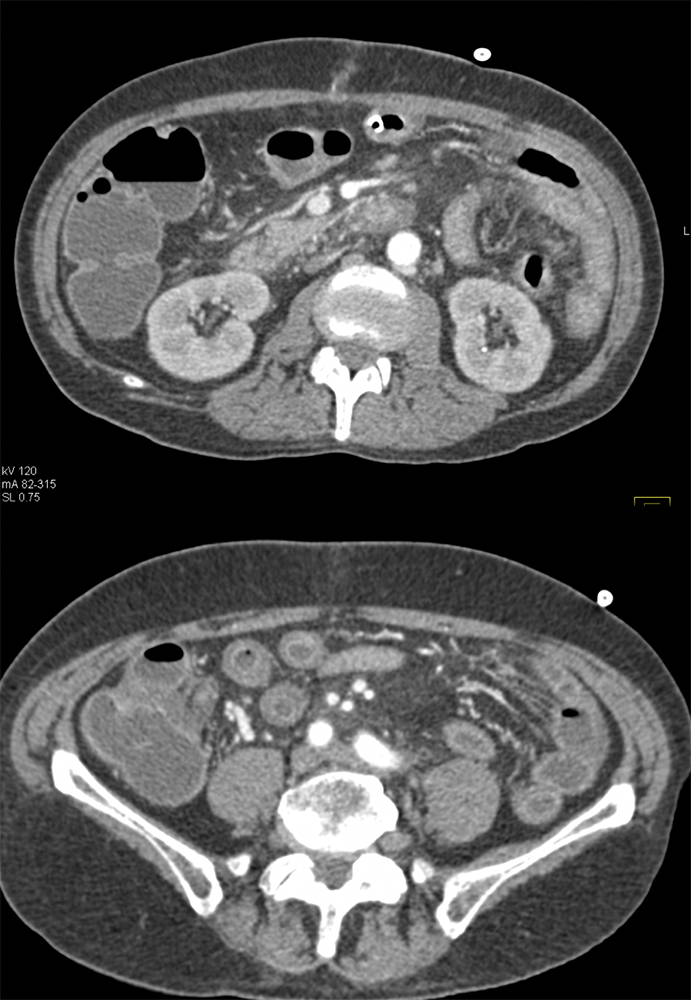 GVH Small Bowel in Patient with  Myeloma and Post BMT