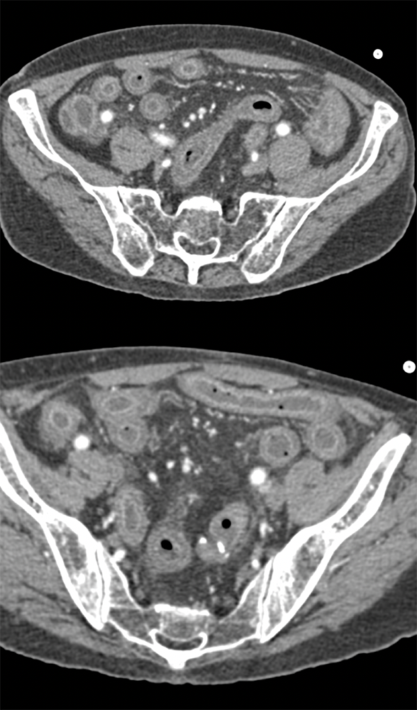 CT of the Small Bowel