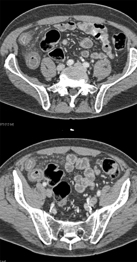 CT of the Small Bowel