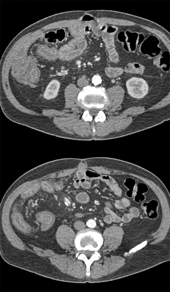 Enteritis due to Chemotherapy in Pancreas Adenocarcinoma