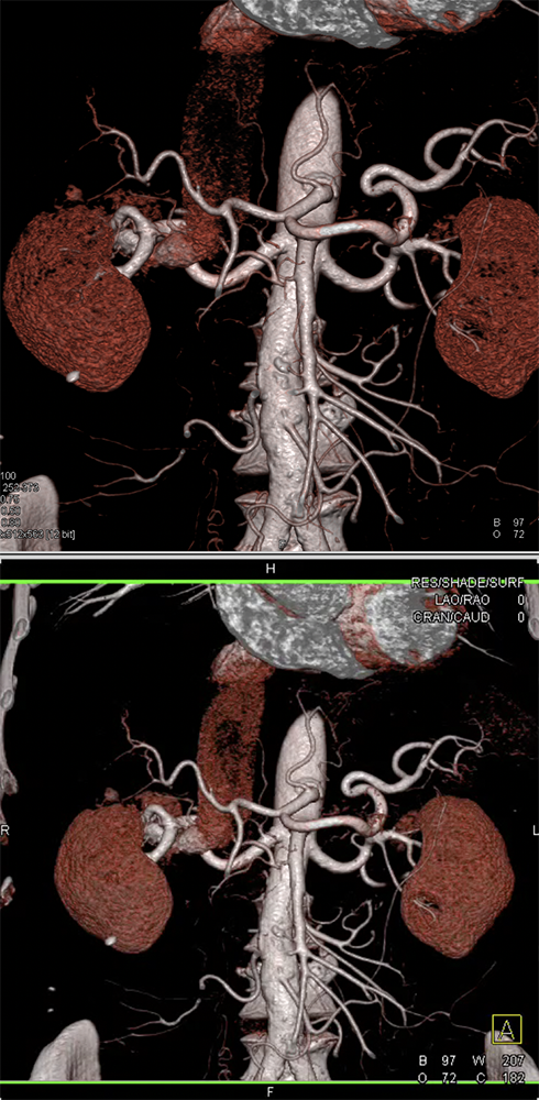 Interactive Volume Rendering of the Pancreas and Arterial Map