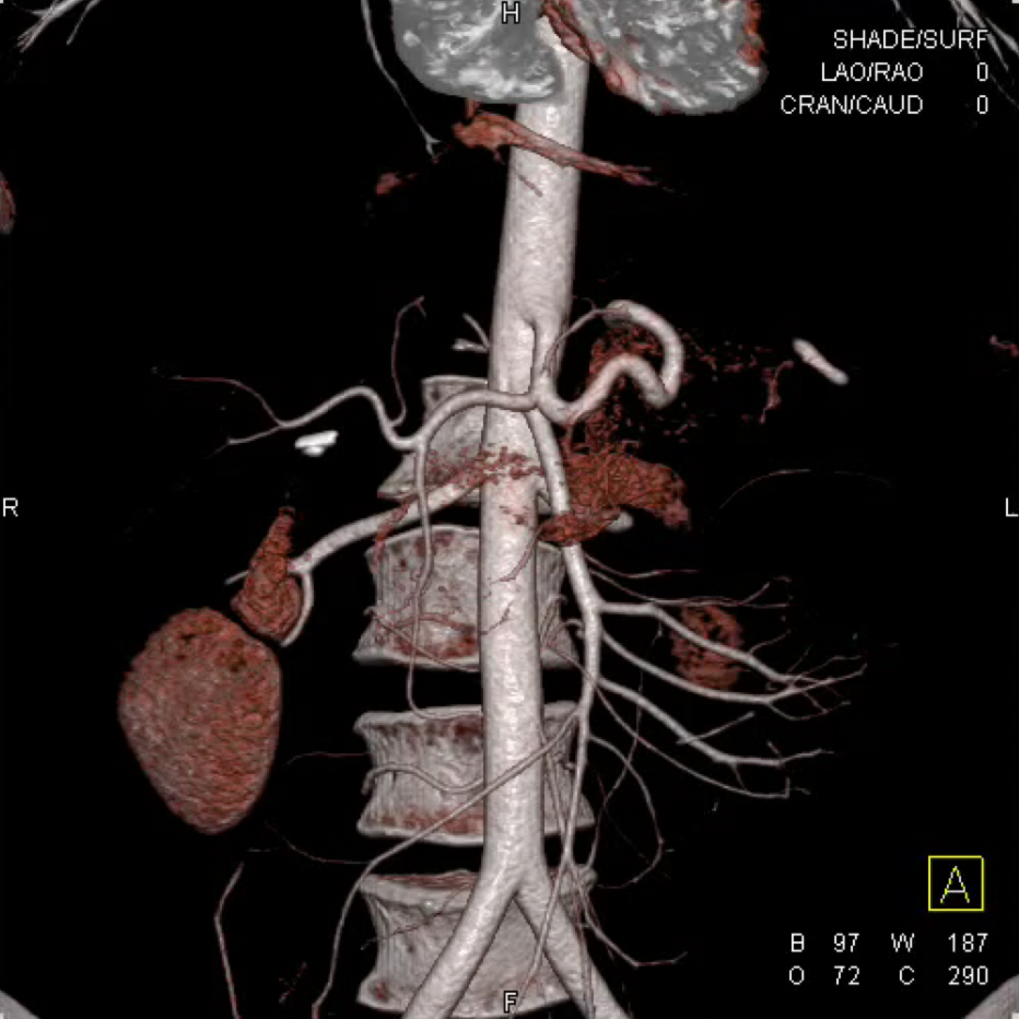 Interactive Volume Rendering of the Pancreas and Arterial Map 