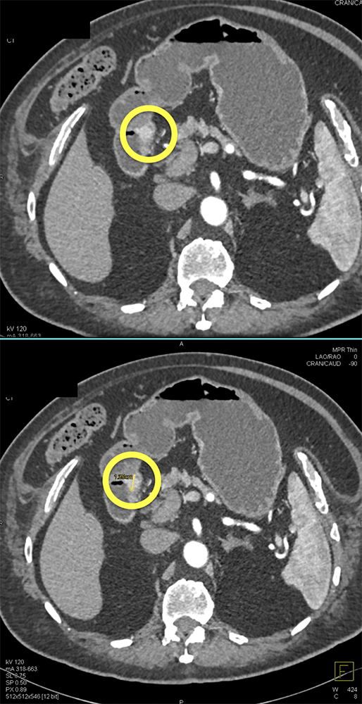 Subtle Tumor Duodenal Carcinoid 