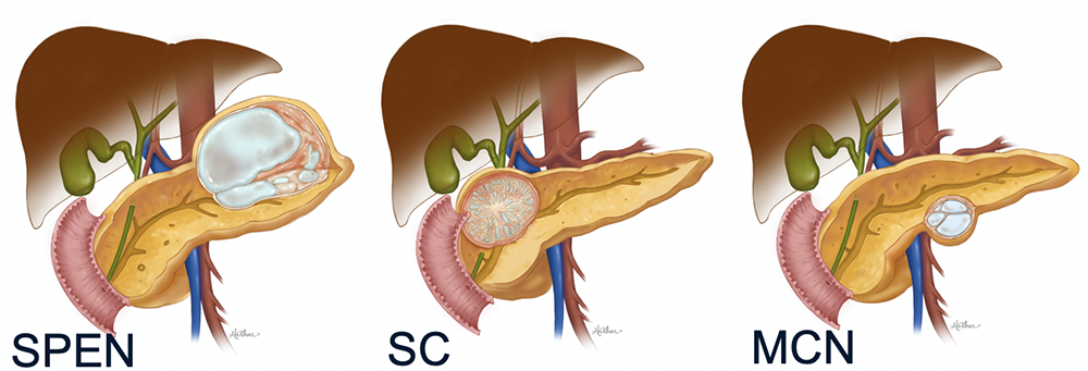 SPEN Tumors of the Pancreas