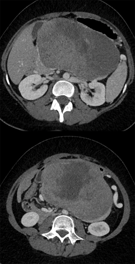 SPEN Tumors of the Pancreas