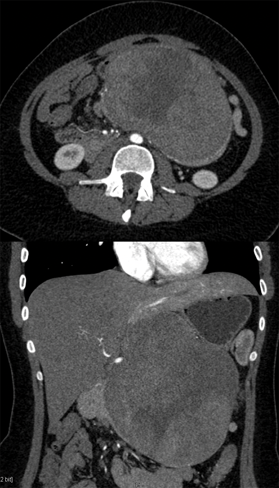 SPEN Tumors of the Pancreas