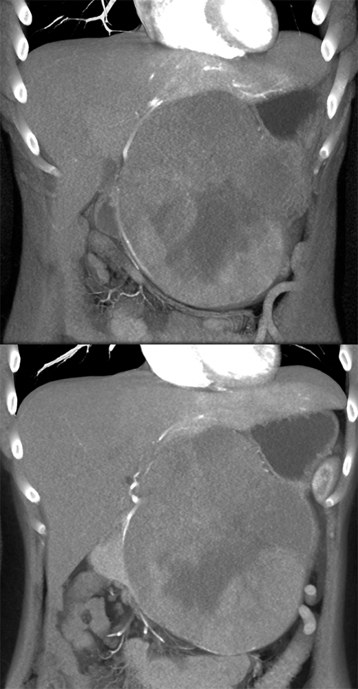 SPEN Tumors of the Pancreas