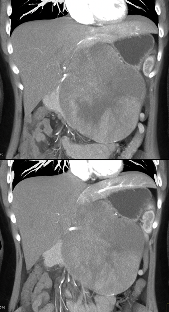 SPEN Tumors of the Pancreas