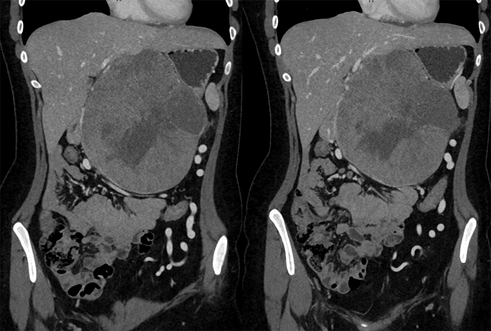 SPEN Tumors of the Pancreas