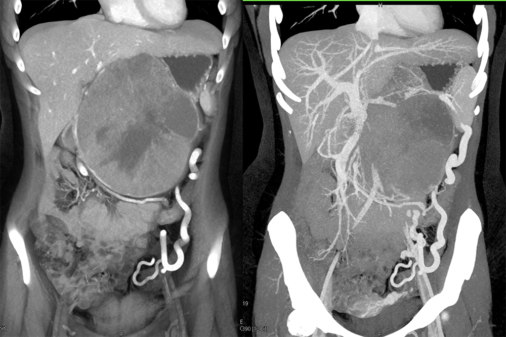 SPEN Tumors of the Pancreas