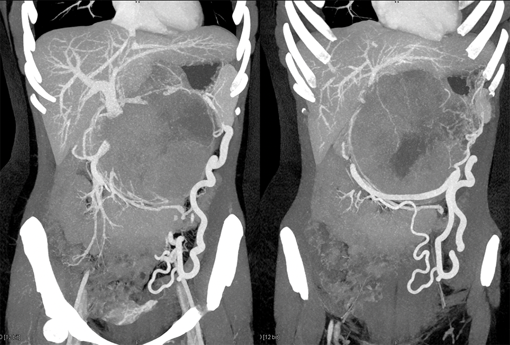 SPEN Tumors of the Pancreas