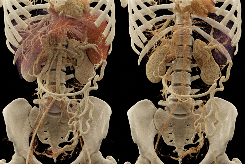 SPEN Tumors of the Pancreas