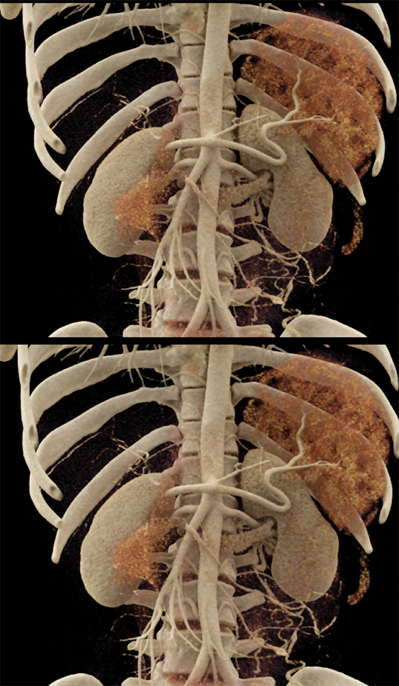 SPEN Tumors of the Pancreas