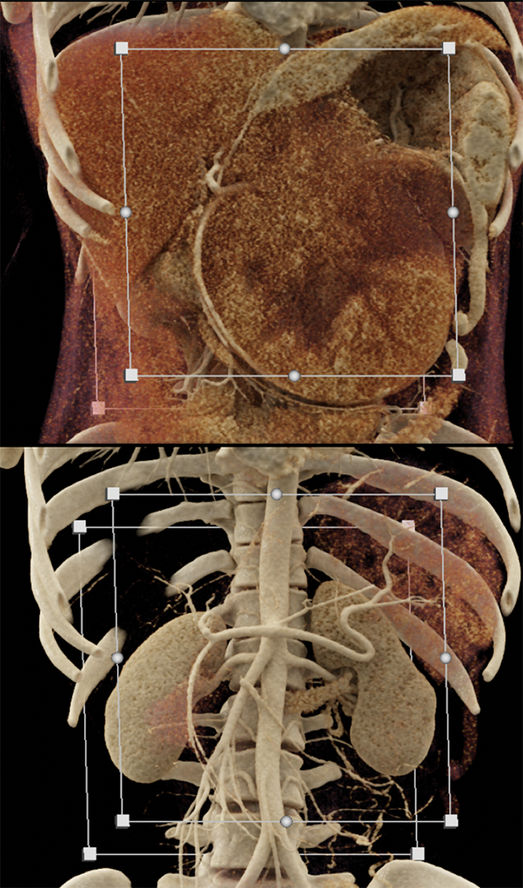 SPEN Tumors of the Pancreas