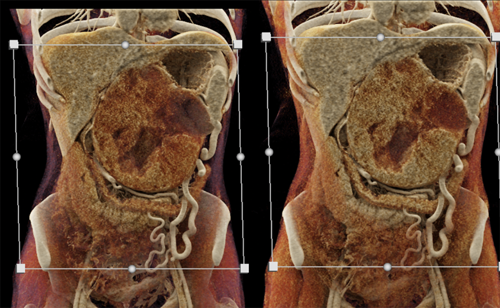 SPEN Tumors of the Pancreas