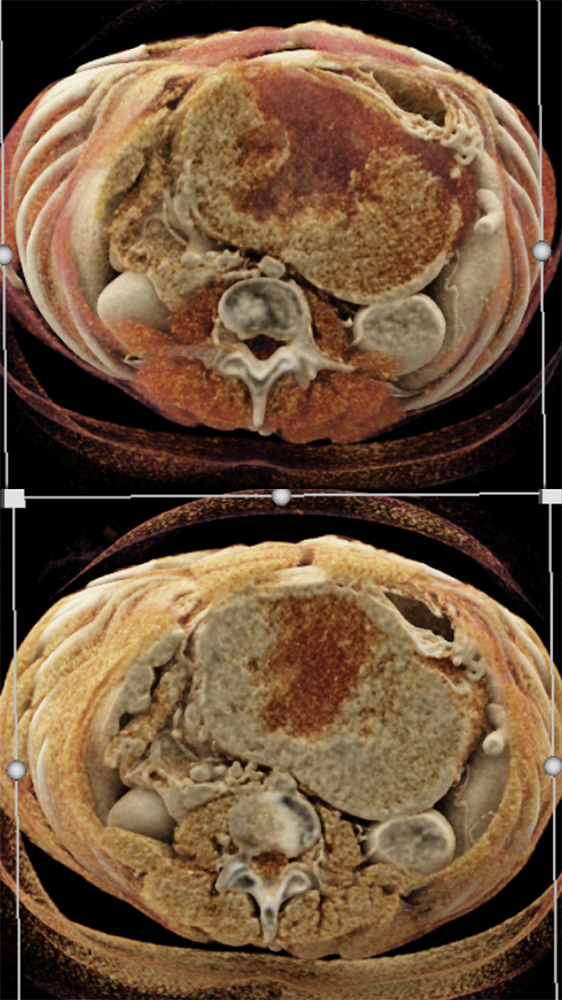 SPEN Tumors of the Pancreas