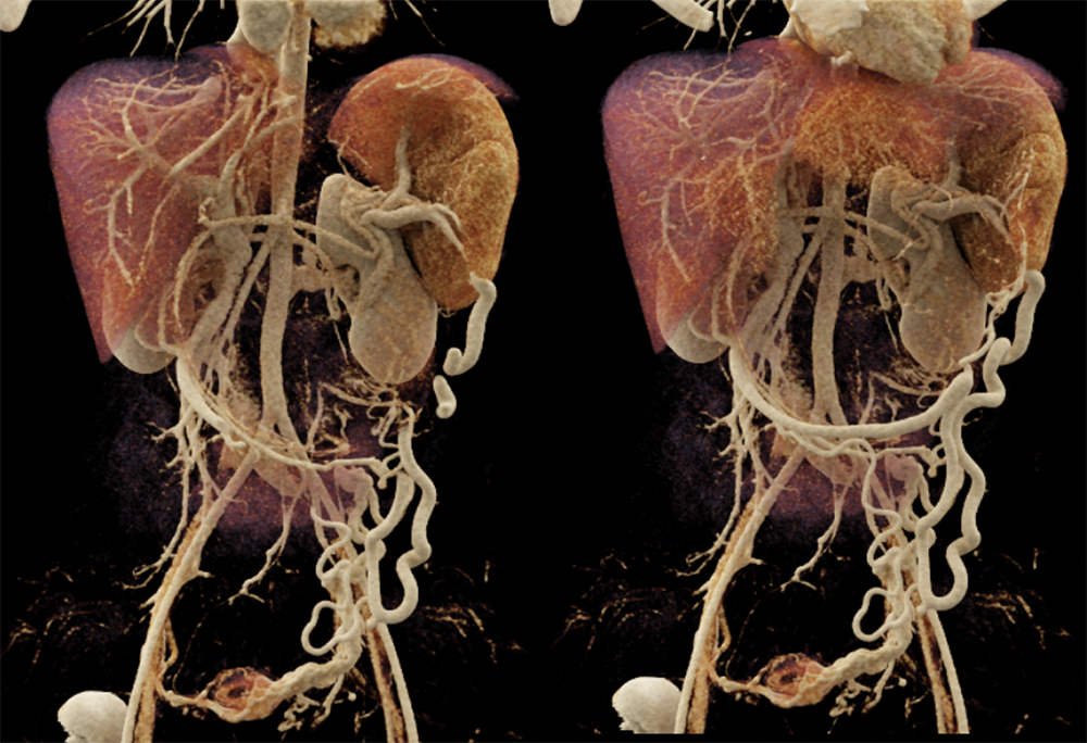 SPEN Tumors of the Pancreas