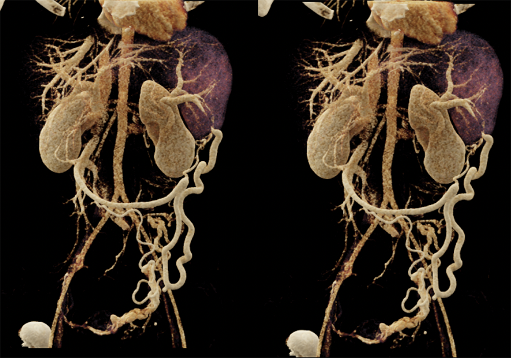 SPEN Tumors of the Pancreas