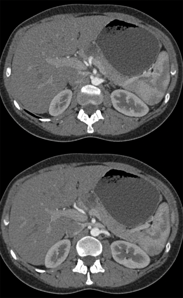 SPEN Tumors of the Pancreas