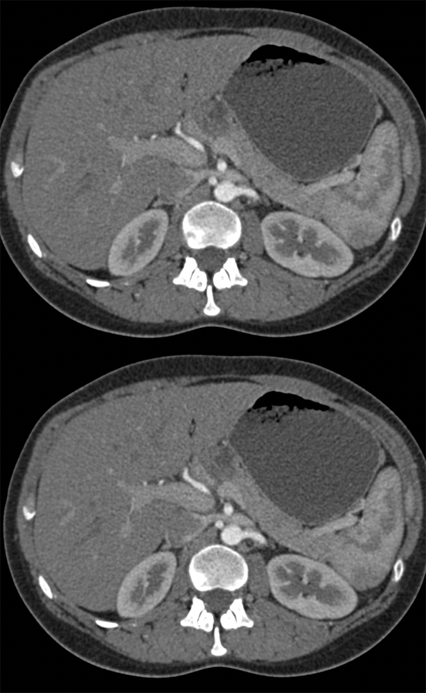 SPEN Tumors of the Pancreas